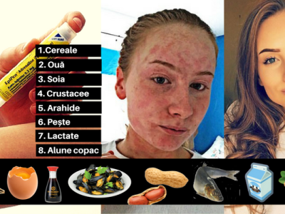 Alergenii, asasinii nevăzuți din mâncarea noastră