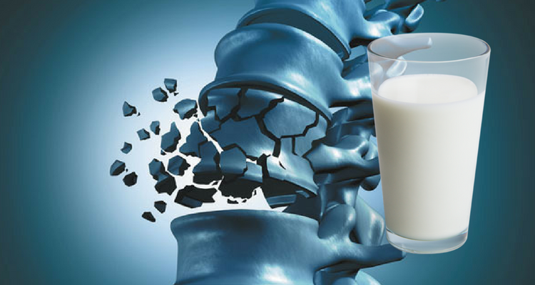 Osteoporoza cauzata de consumul de lactate
